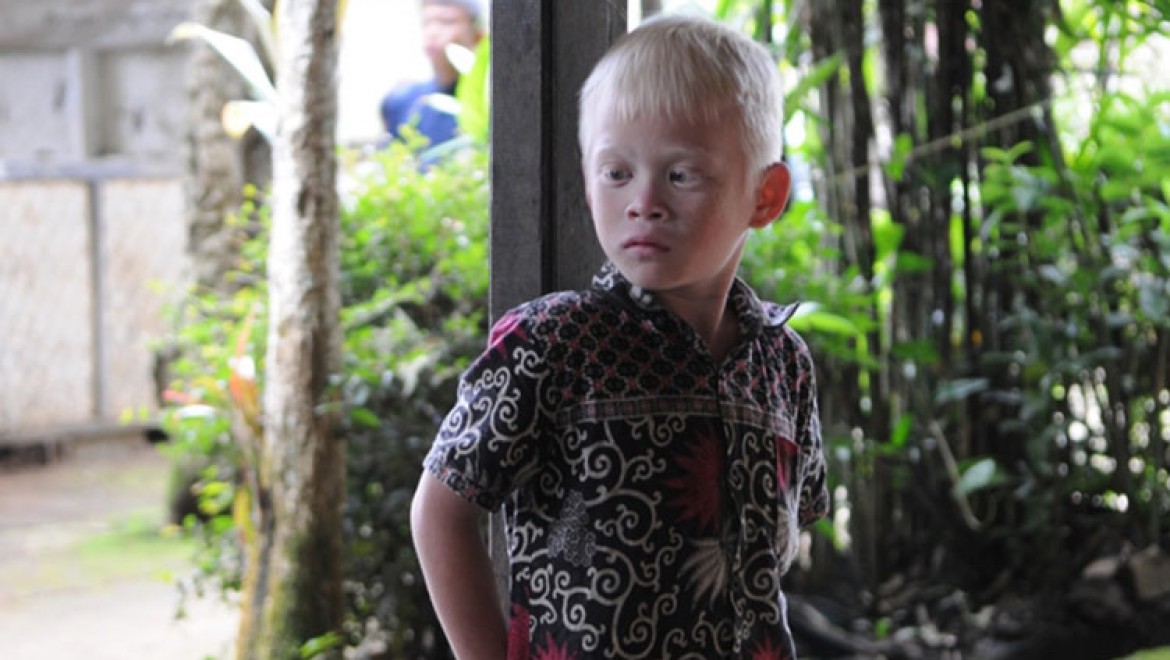 Albinizmli bireyler, dünya genelinde insan hakları ihlallerine maruz kalıyor