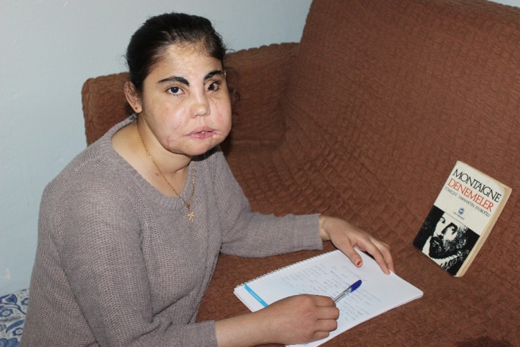 Türkiye'nin yüz nakli yapılan ilk kadını hayatını kaybetti